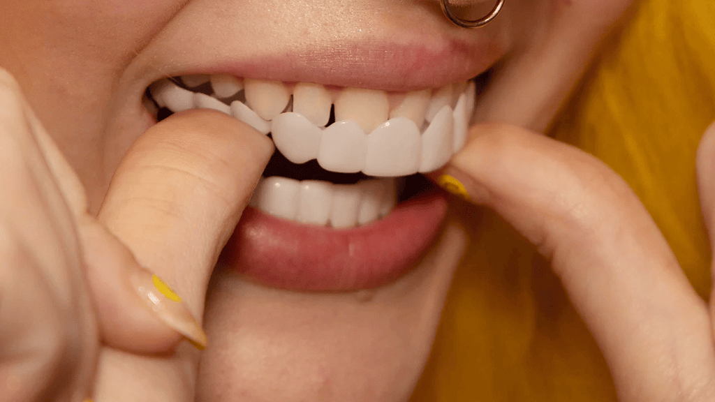 Snap-On Veneers for Upper and Lower Teeth for an Instant Natural Smile