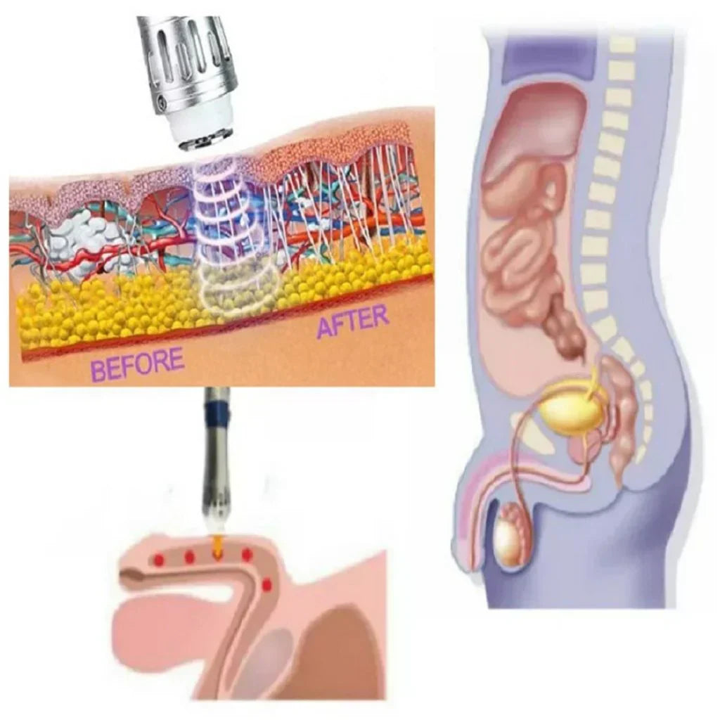Portable ED Shockwave Therapy Device for Men