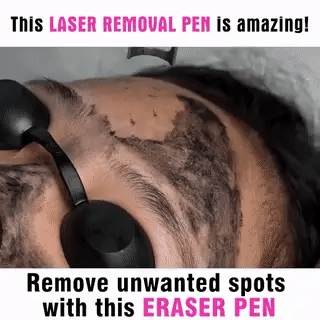 Laser Pen for Tattoo, Mole, and Freckle Removal